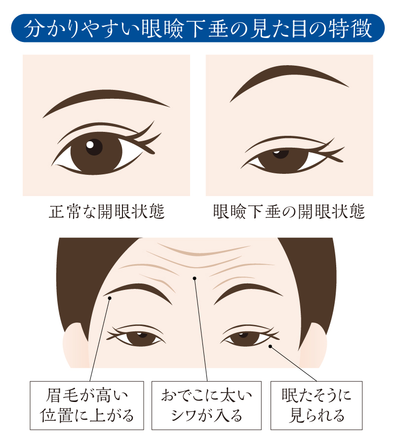 眼瞼 下垂 軽度 眼瞼下垂について 代表的な原因と症状 対策方法まとめ Amp Petmd Com